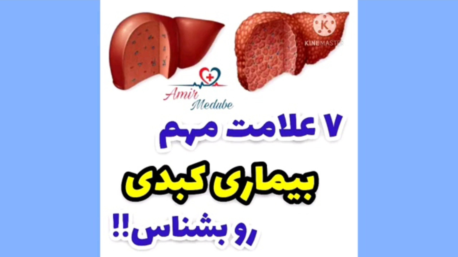 ۷ علامت مهم بیماری کبدی (هپاتیت) مثل کبد چرب چیست؟